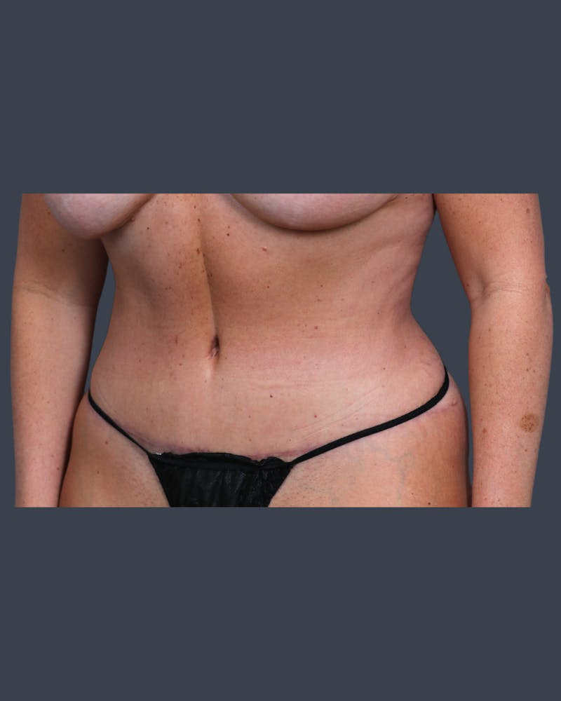 Abdominoplasty / Tummy Tuck Before & After Gallery - Patient 237625 - Image 4