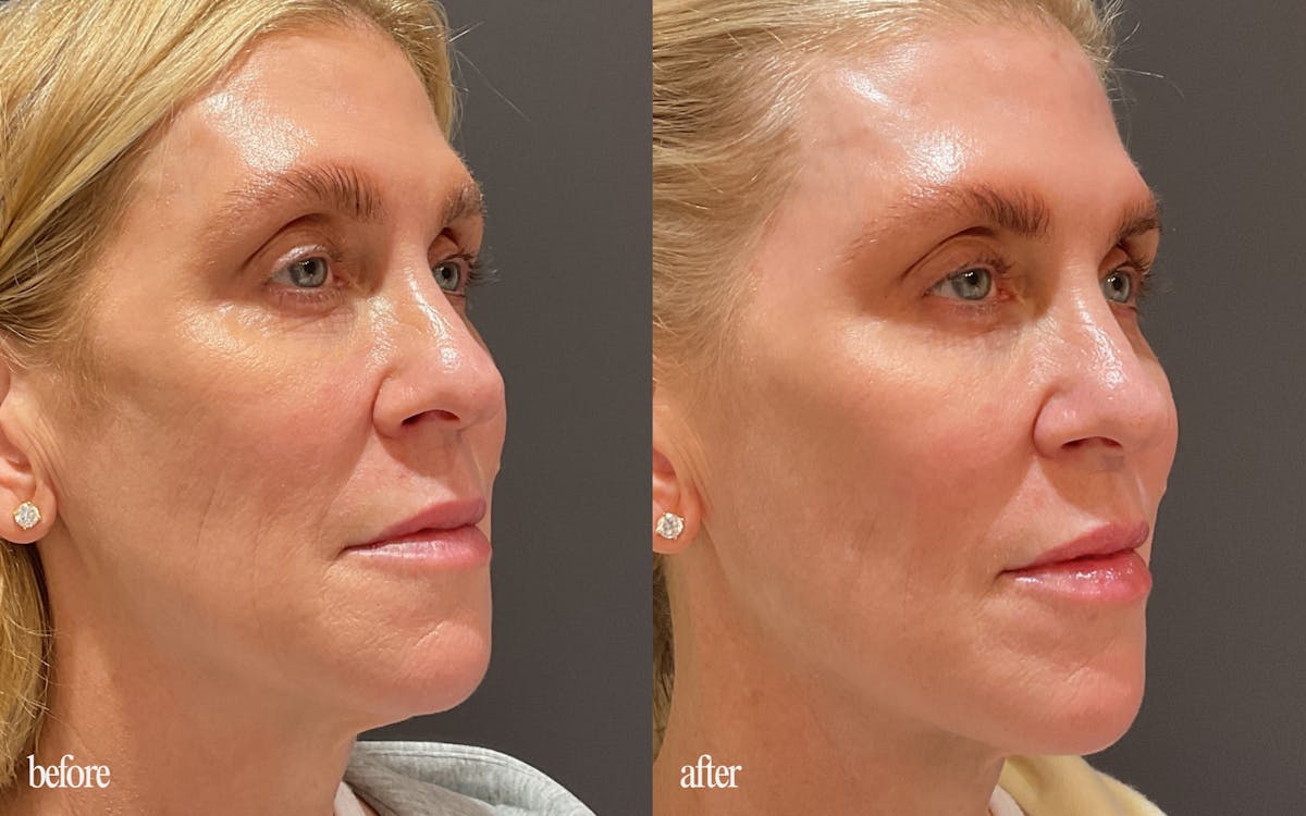 Facial Balancing Before & After Gallery - Patient 369687 - Image 1