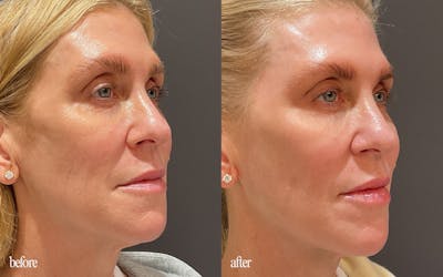 Facial Balancing Before & After Gallery - Patient 369687 - Image 1