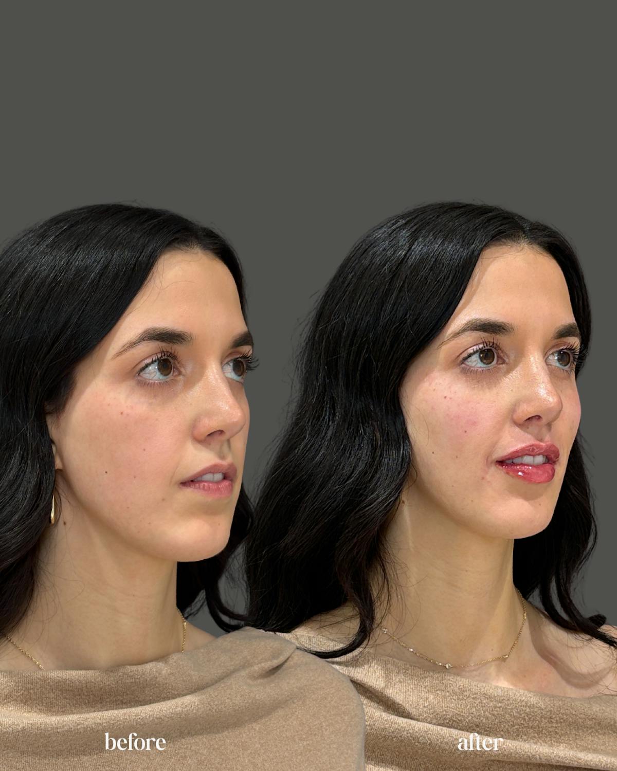 Facial Balancing Before & After Gallery - Patient 277222 - Image 1