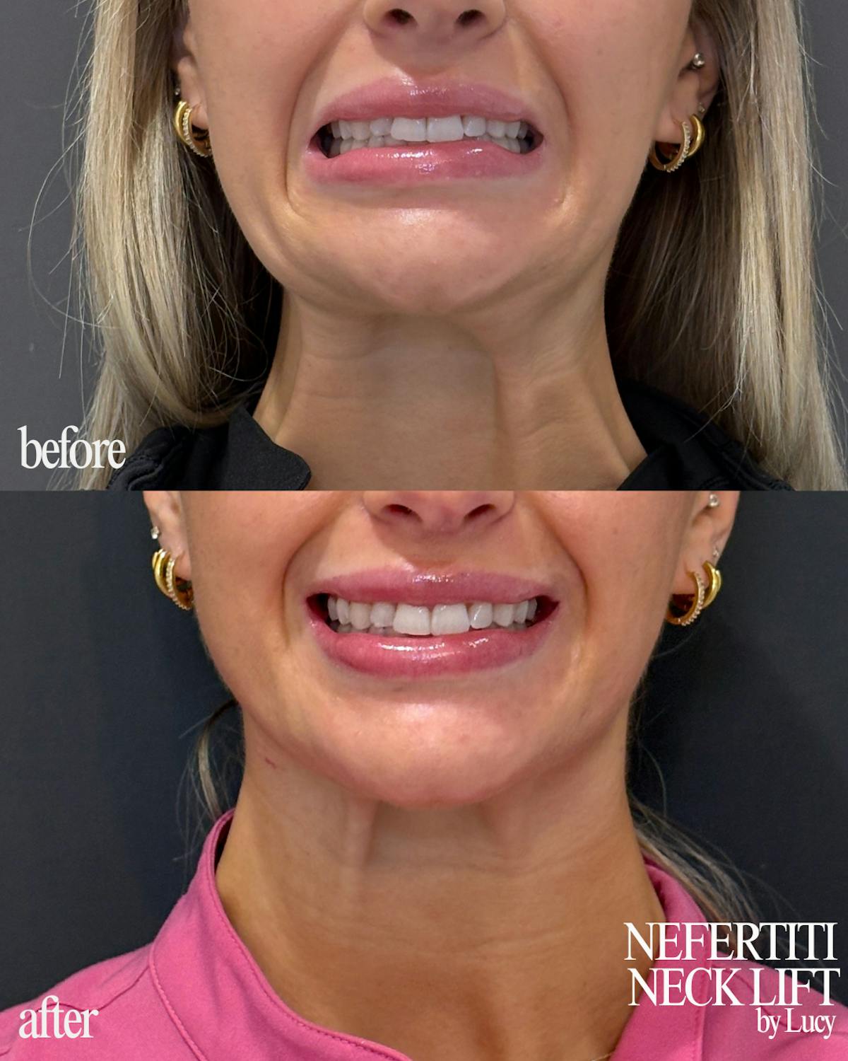 Nefertiti Neck Lift Before & After Gallery - Patient 847796 - Image 1