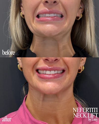 Nefertiti Neck Lift Before & After Gallery - Patient 847796 - Image 1