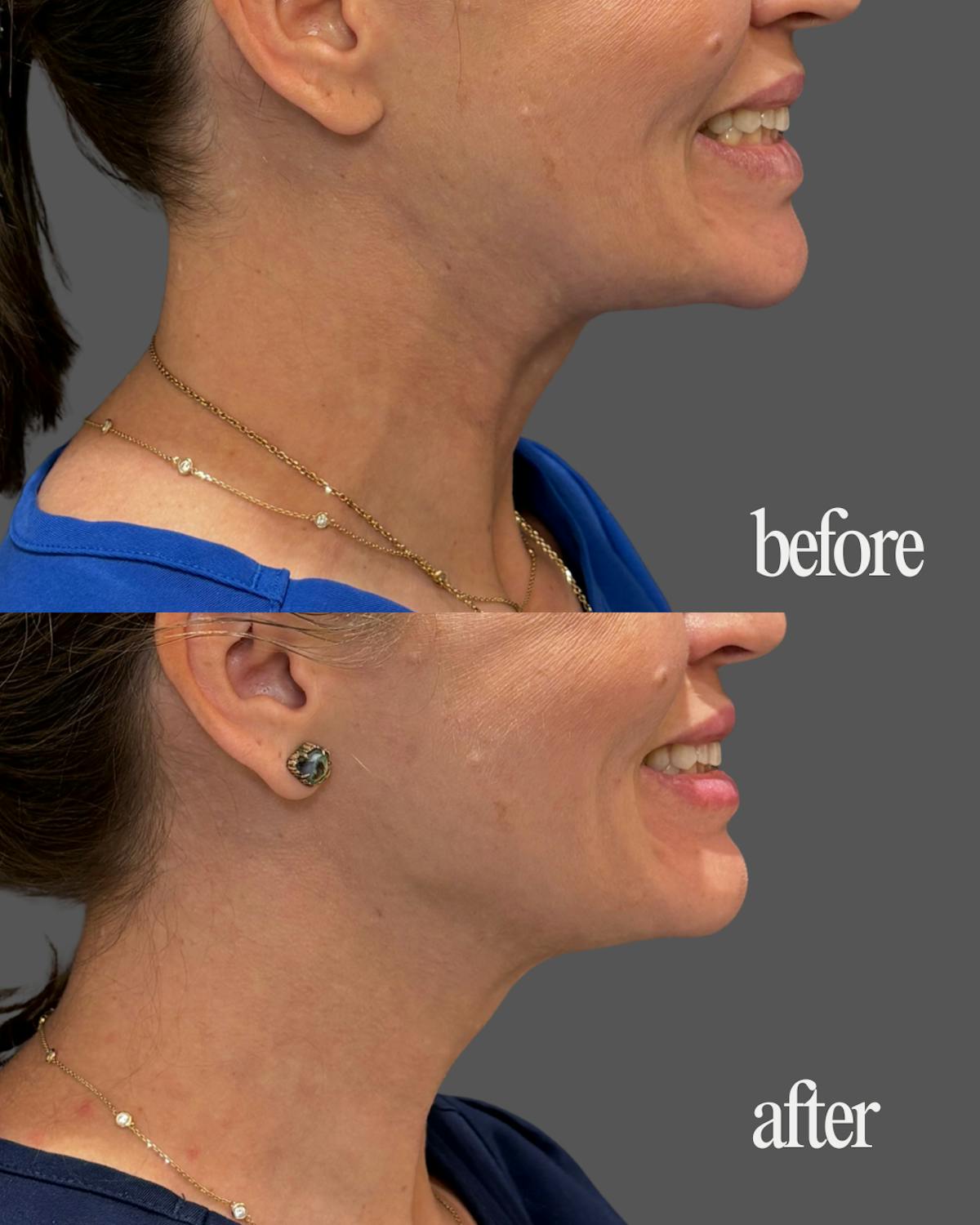Nefertiti Neck Lift Before & After Gallery - Patient 275980 - Image 2