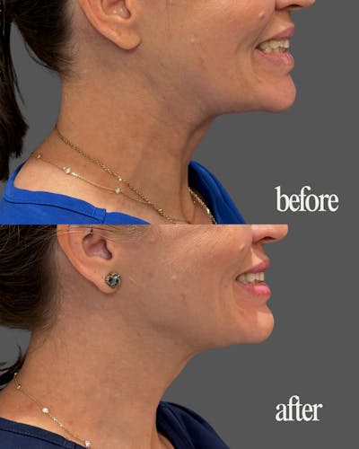 Nefertiti Neck Lift Before & After Gallery - Patient 275980 - Image 2