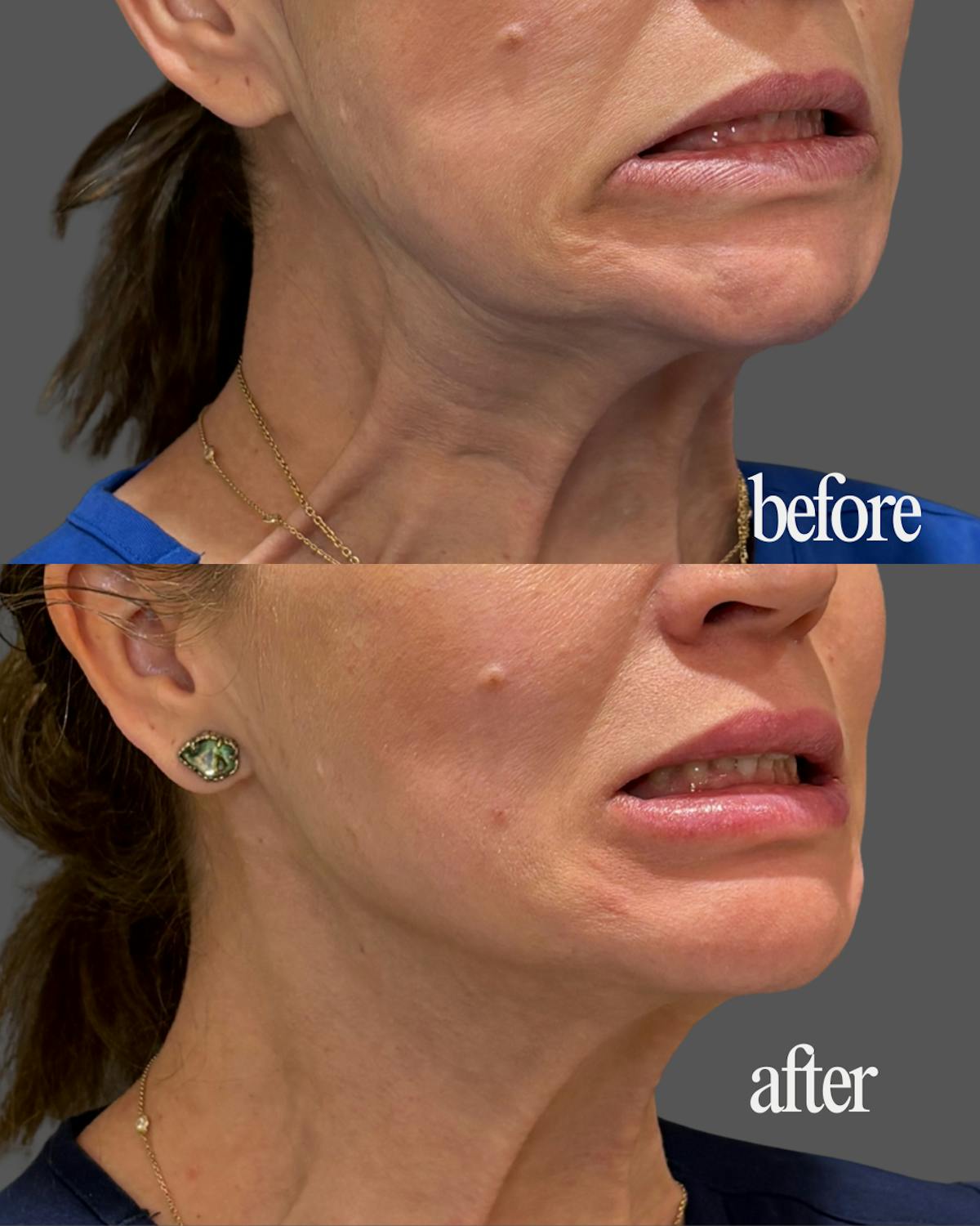 Nefertiti Neck Lift Before & After Gallery - Patient 275980 - Image 1