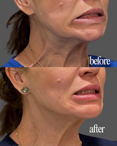 Nefertiti Neck Lift Before & After Gallery - Patient 275980 - Image 1