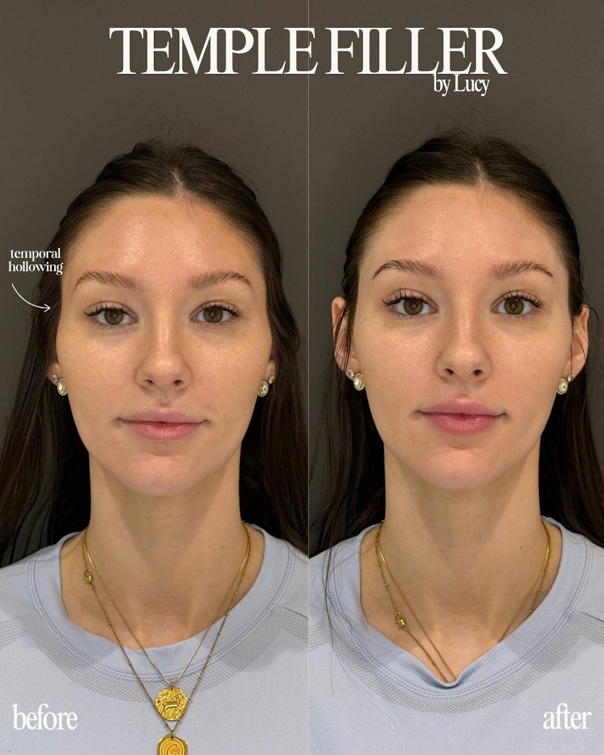 Filler Before & After Gallery - Patient 376718 - Image 1
