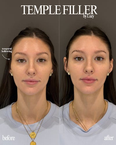 Filler Before & After Gallery - Patient 376718 - Image 1
