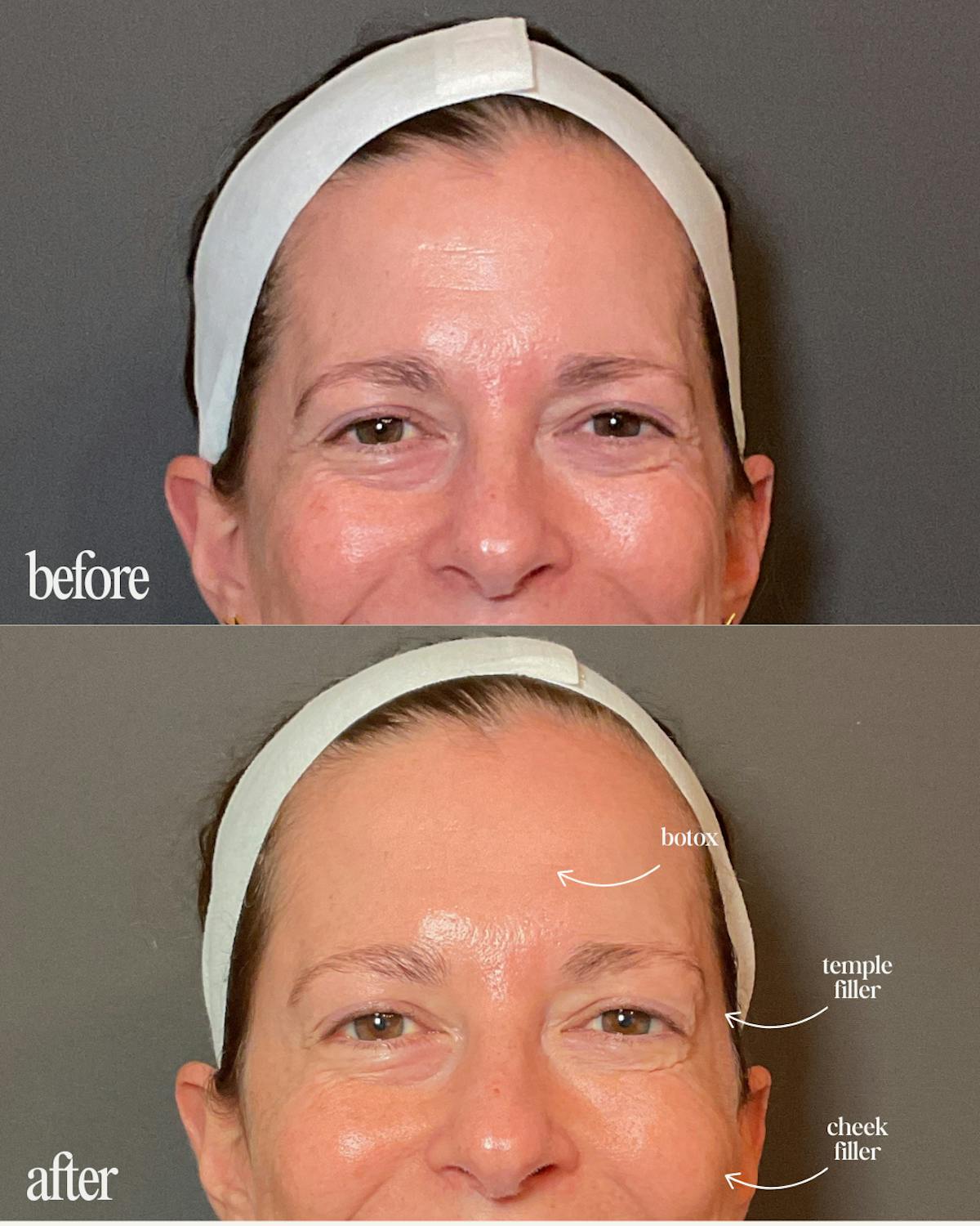 Filler Before & After Gallery - Patient 104379 - Image 1