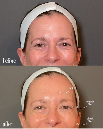 Filler Before & After Gallery - Patient 104379 - Image 1