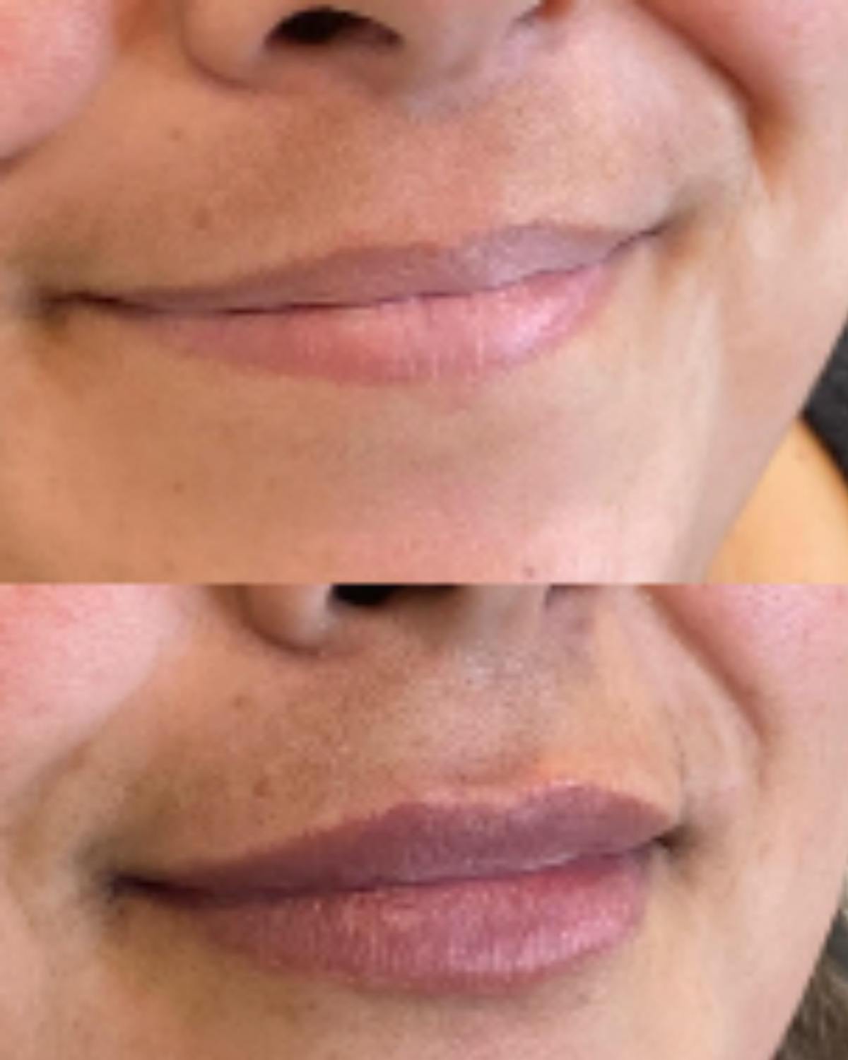 Lip Filler Before & After Gallery - Patient 125909 - Image 1