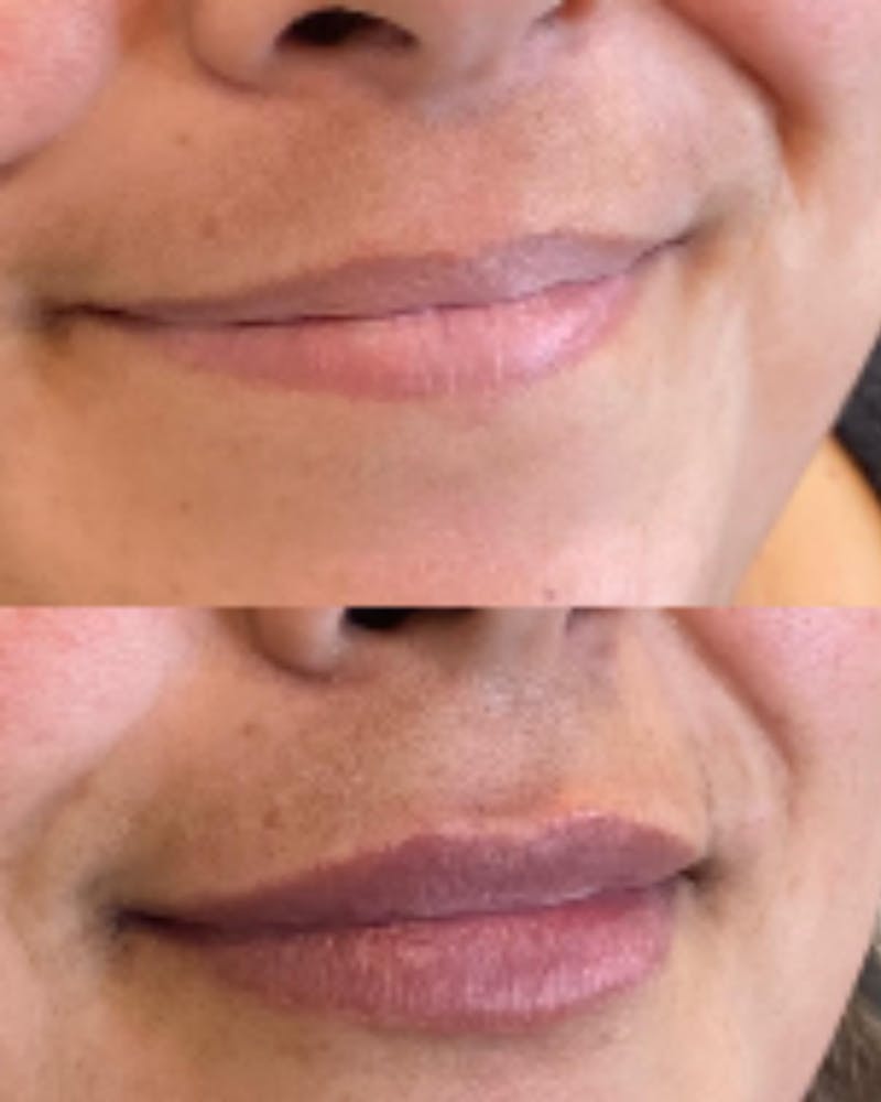 Lip Filler Before & After Gallery - Patient 125909 - Image 1