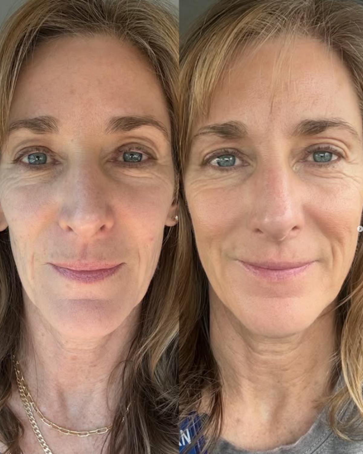 Facial Balancing Before & After Gallery - Patient 194423 - Image 1