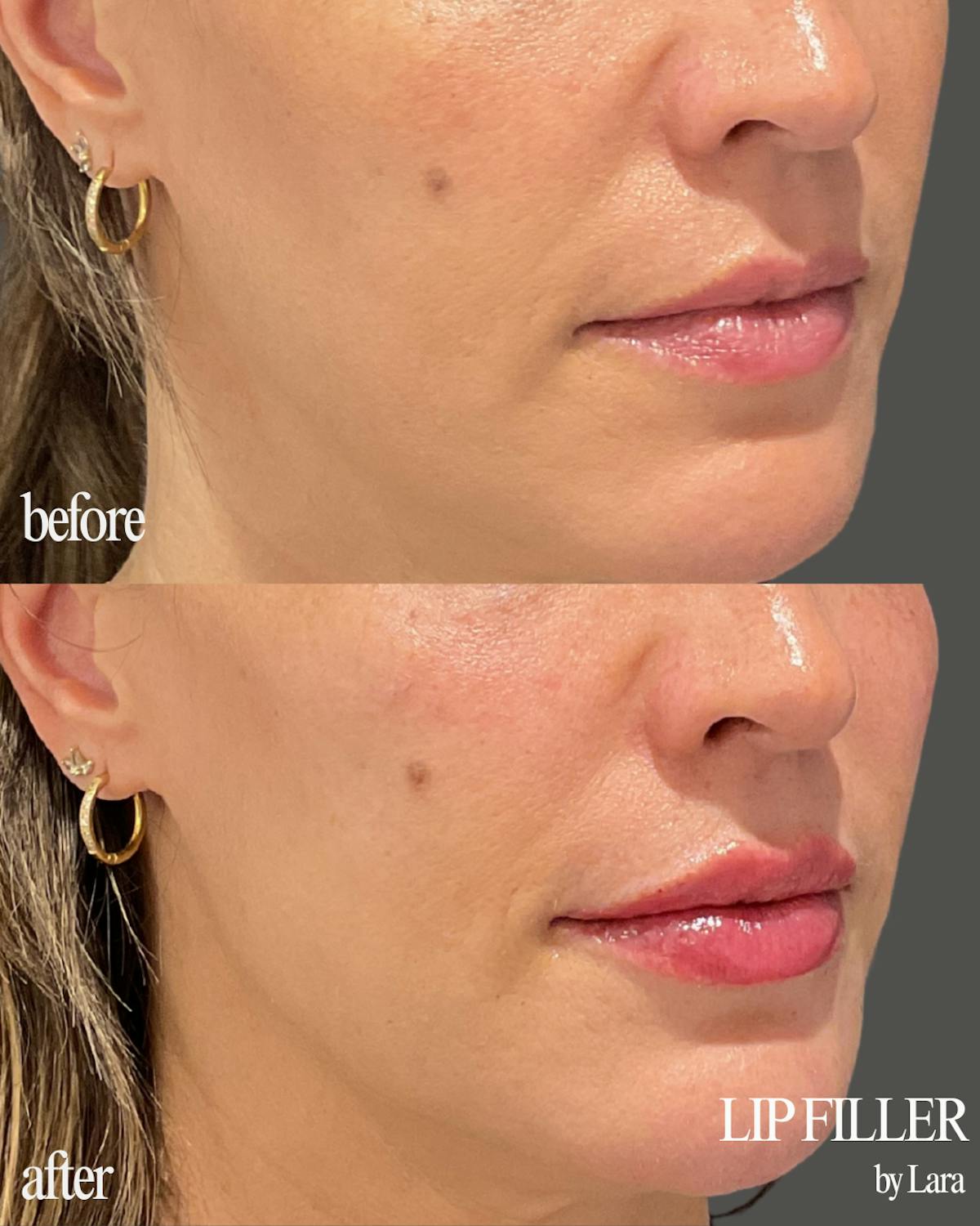 Lip Filler Before & After Gallery - Patient 268185 - Image 1