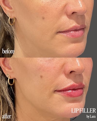 Lip Filler Before & After Gallery - Patient 268185 - Image 1
