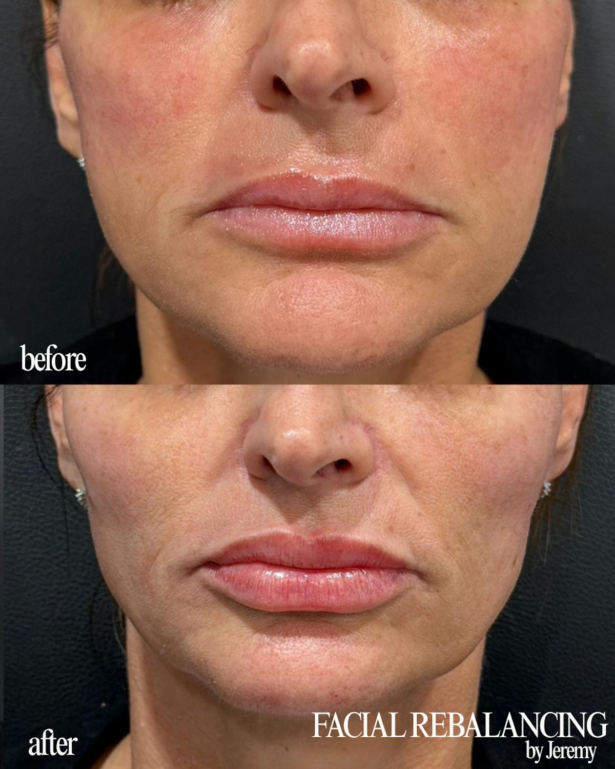 Facial Balancing Before & After Gallery - Patient 400198 - Image 1