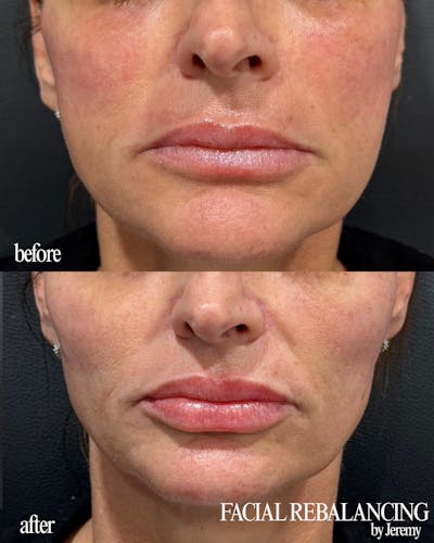 Facial Balancing Before & After Gallery - Patient 400198 - Image 1