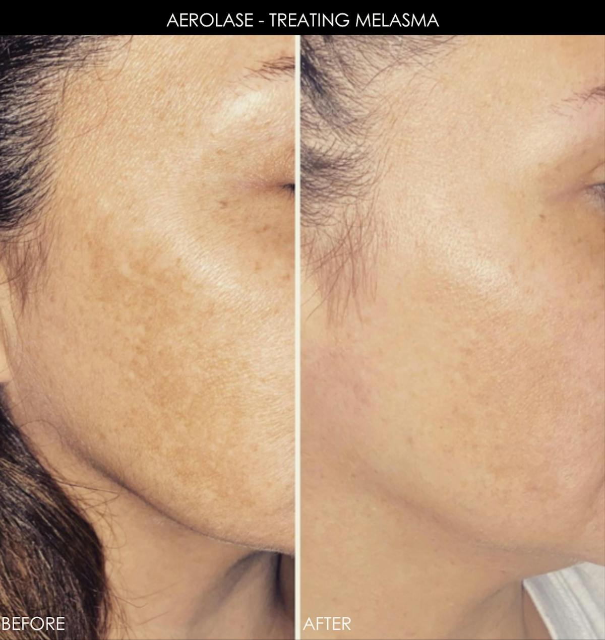 Aerolase Before & After Gallery - Patient 353898 - Image 1