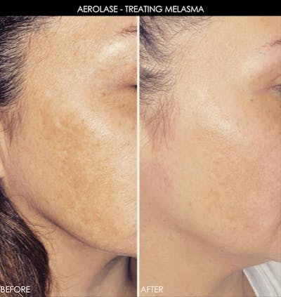 Aerolase Before & After Gallery - Patient 353898 - Image 1