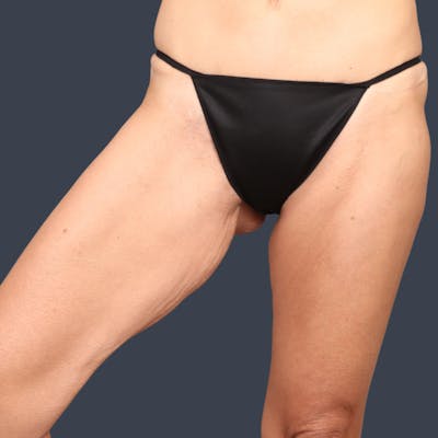 Thigh Lift Before & After Gallery - Patient 199749 - Image 1