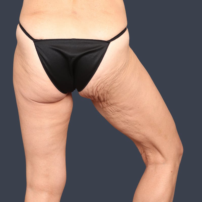 Thigh Lift Before & After Gallery - Patient 199749 - Image 3