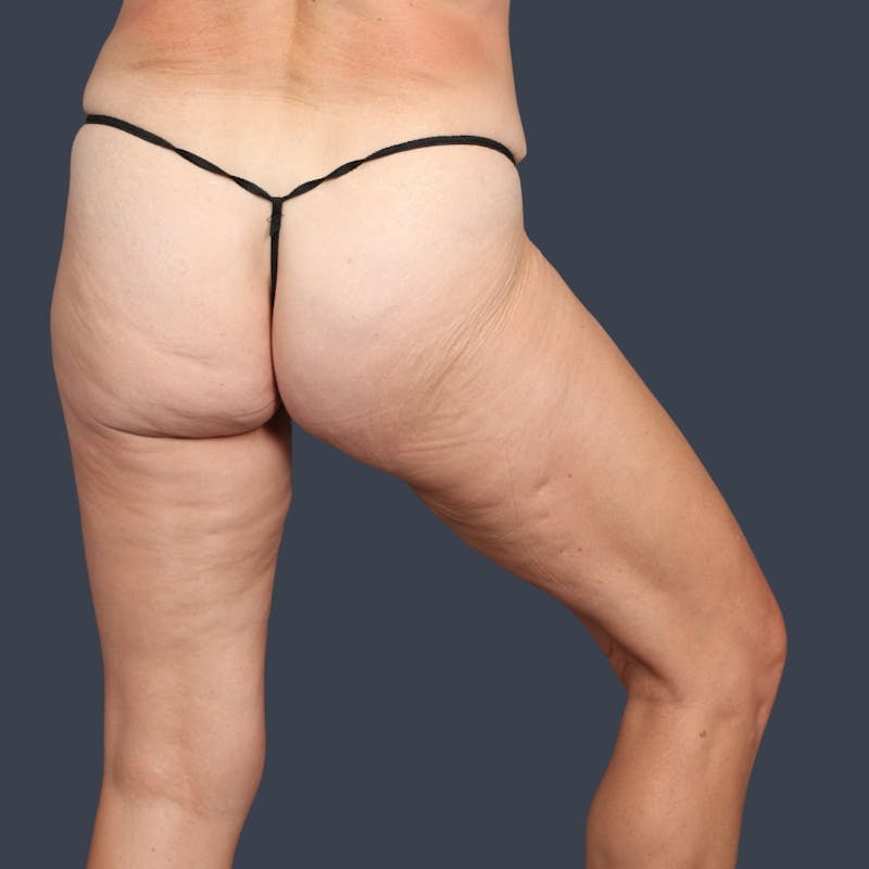 Thigh Lift Before & After Gallery - Patient 199749 - Image 4