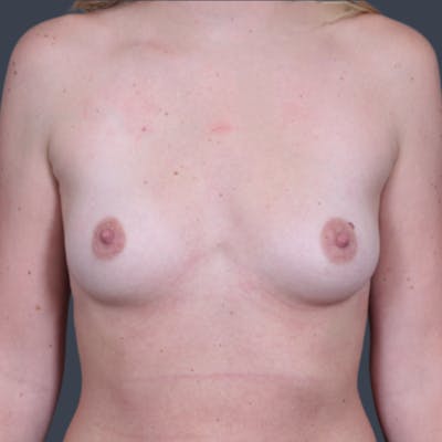 Breast Augmentation  Before & After Gallery - Patient 612421 - Image 1