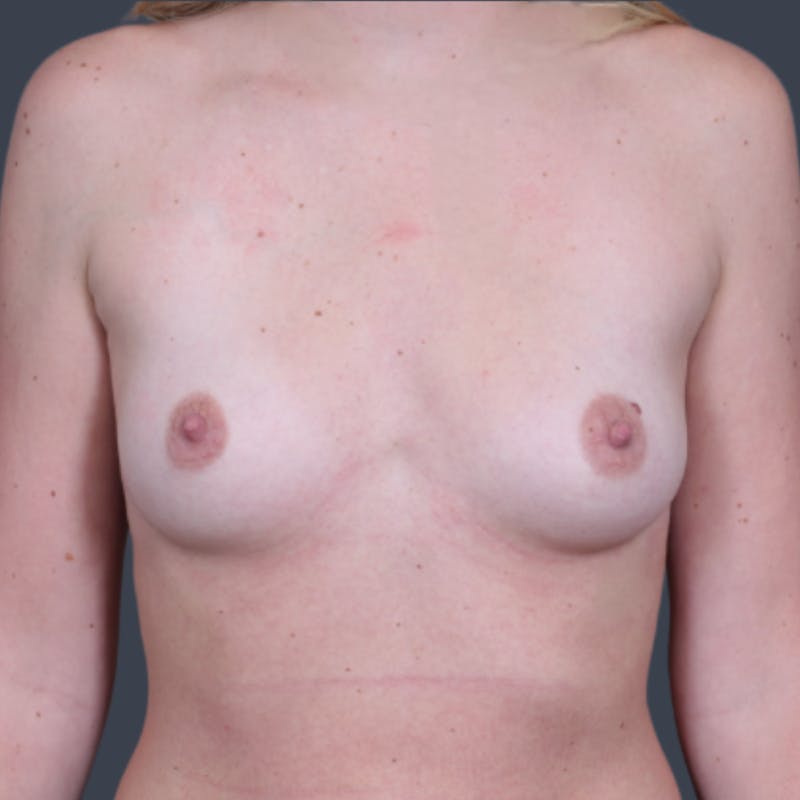 Breast Augmentation  Before & After Gallery - Patient 612421 - Image 1