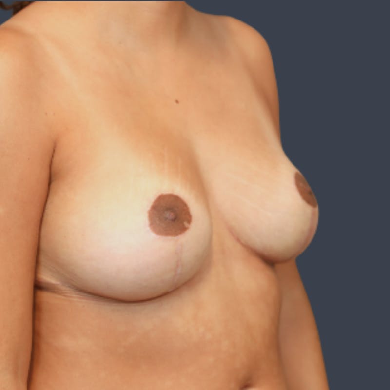 Breast Reduction Before & After Gallery - Patient 657457 - Image 4