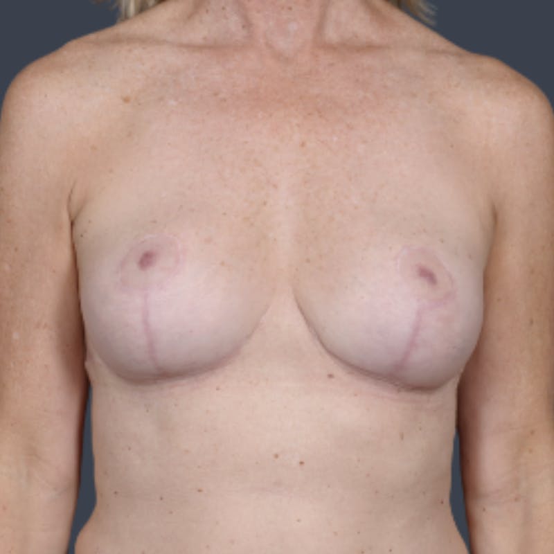 Breast Reduction Before & After Gallery - Patient 144077 - Image 2