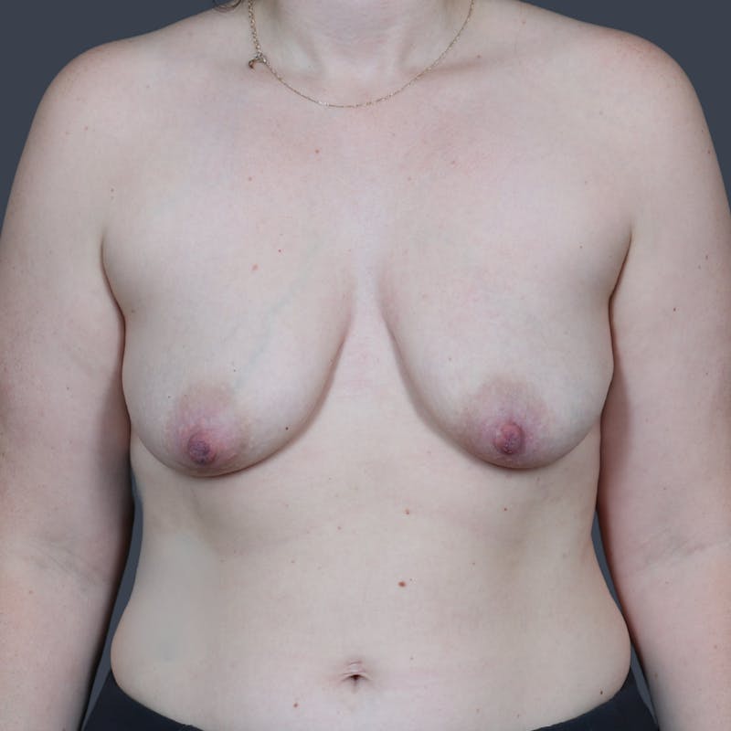 Breast Augmentation  Before & After Gallery - Patient 255363 - Image 1