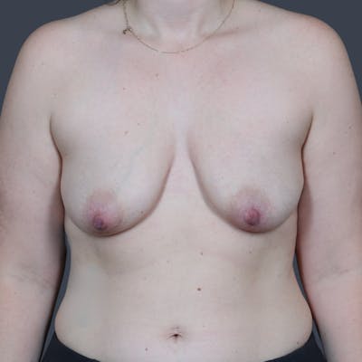 Breast Augmentation Before & After Gallery - Patient 255363 - Image 1