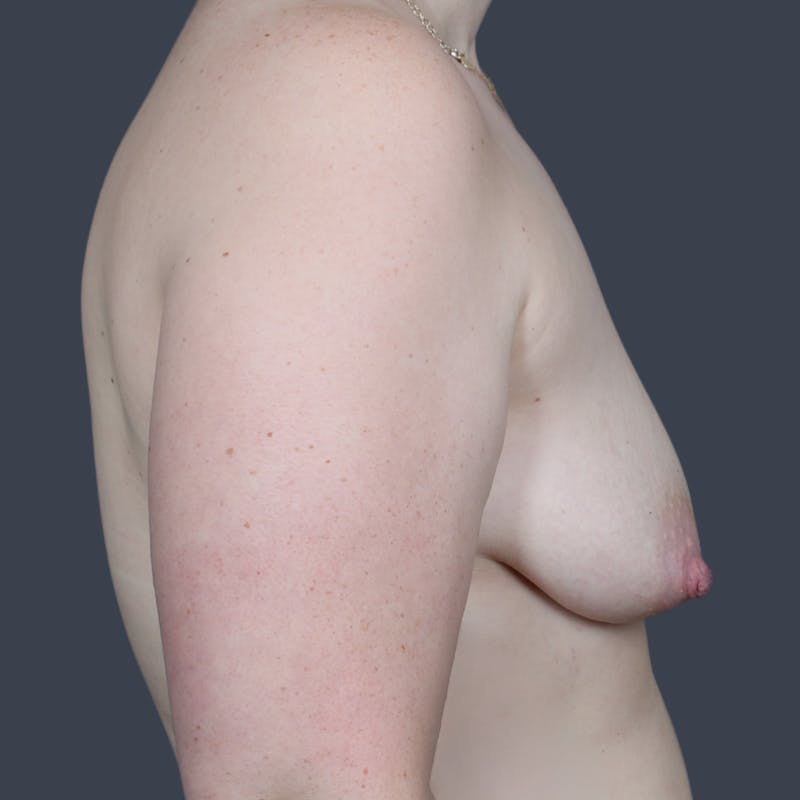 Breast Augmentation  Before & After Gallery - Patient 255363 - Image 3