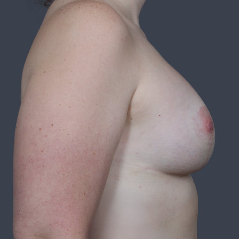 Breast Augmentation  Before & After Gallery - Patient 255363 - Image 4