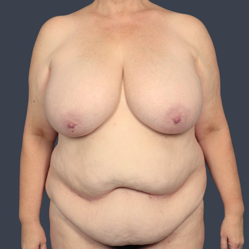 Mommy Makeover Before & After Gallery - Patient 419451 - Image 1