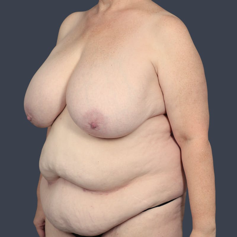 Mommy Makeover Before & After Gallery - Patient 419451 - Image 3