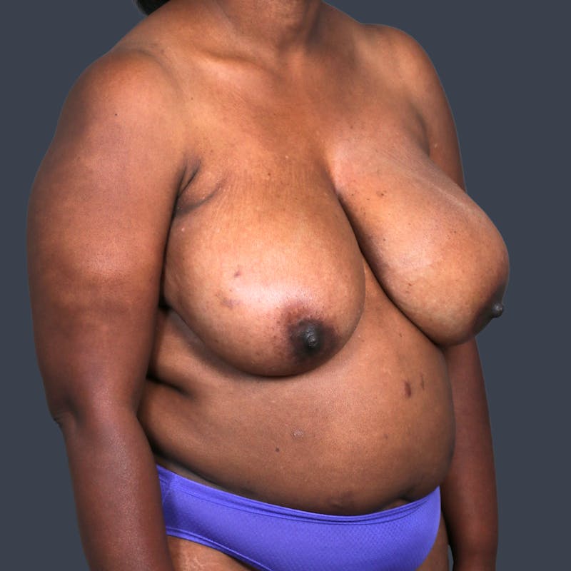 DIEP Flap Before & After Gallery - Patient 343425 - Image 3