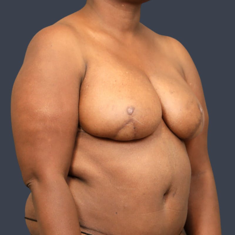 DIEP Flap Before & After Gallery - Patient 343425 - Image 4