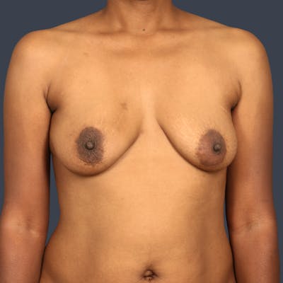Implant Breast Reconstruction Before & After Gallery - Patient 368110 - Image 1