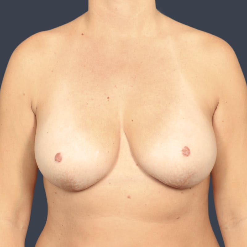 Implant Breast Reconstruction Before & After Gallery - Patient 396063 - Image 2