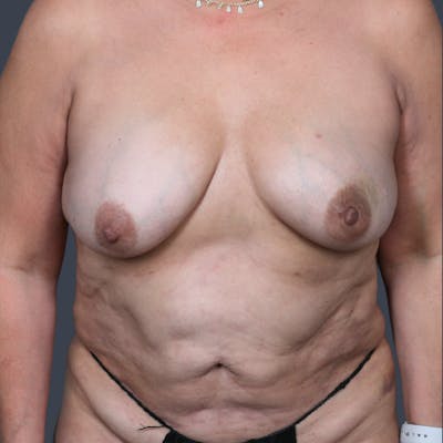 Implant Breast Reconstruction Before & After Gallery - Patient 165196 - Image 1
