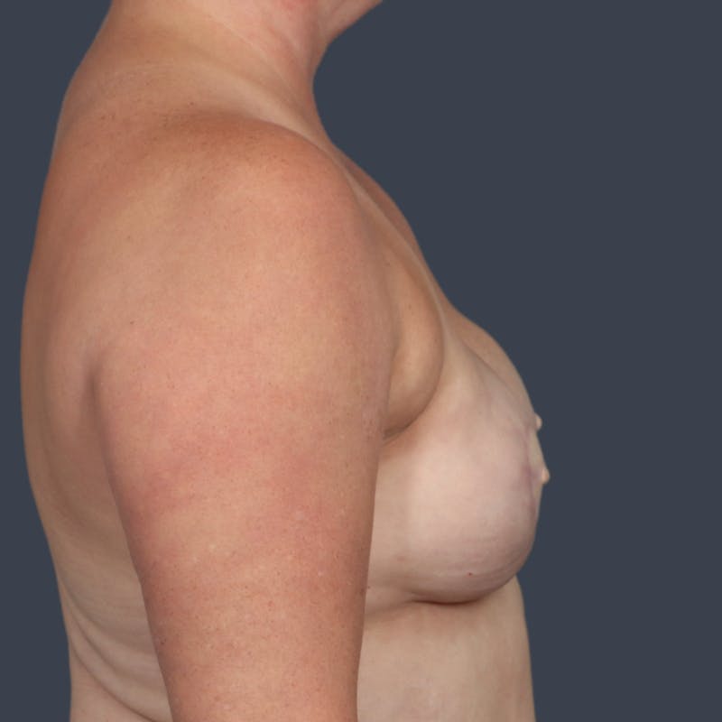 DIEP Flap Before & After Gallery - Patient 415809 - Image 3