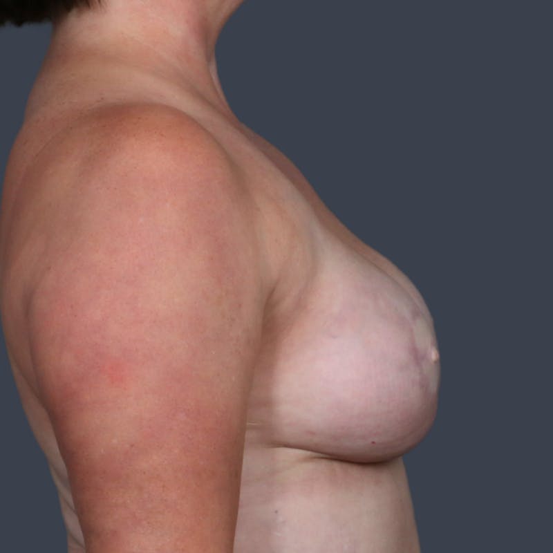 DIEP Flap Before & After Gallery - Patient 415809 - Image 4
