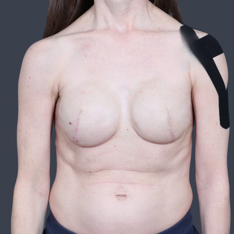 Direct to Implant Breast Reconstruction Before & After Gallery - Patient 187904 - Image 2