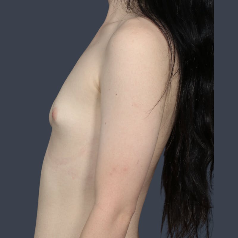 Implant Breast Reconstruction Before & After Gallery - Patient 345040 - Image 3