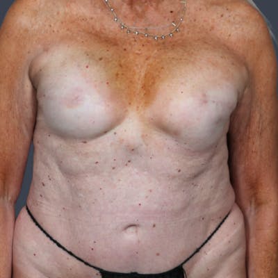 Breast Reconstruction Revision Before & After Gallery - Patient 134610 - Image 1