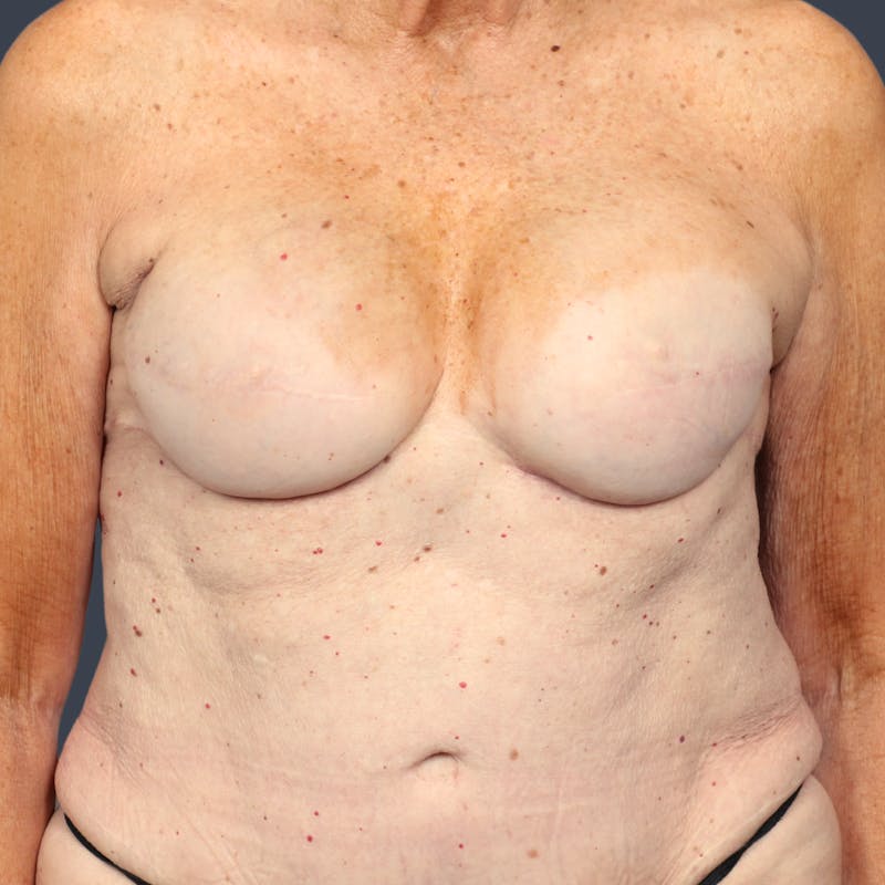 Breast Reconstruction Revision Before & After Gallery - Patient 134610 - Image 2
