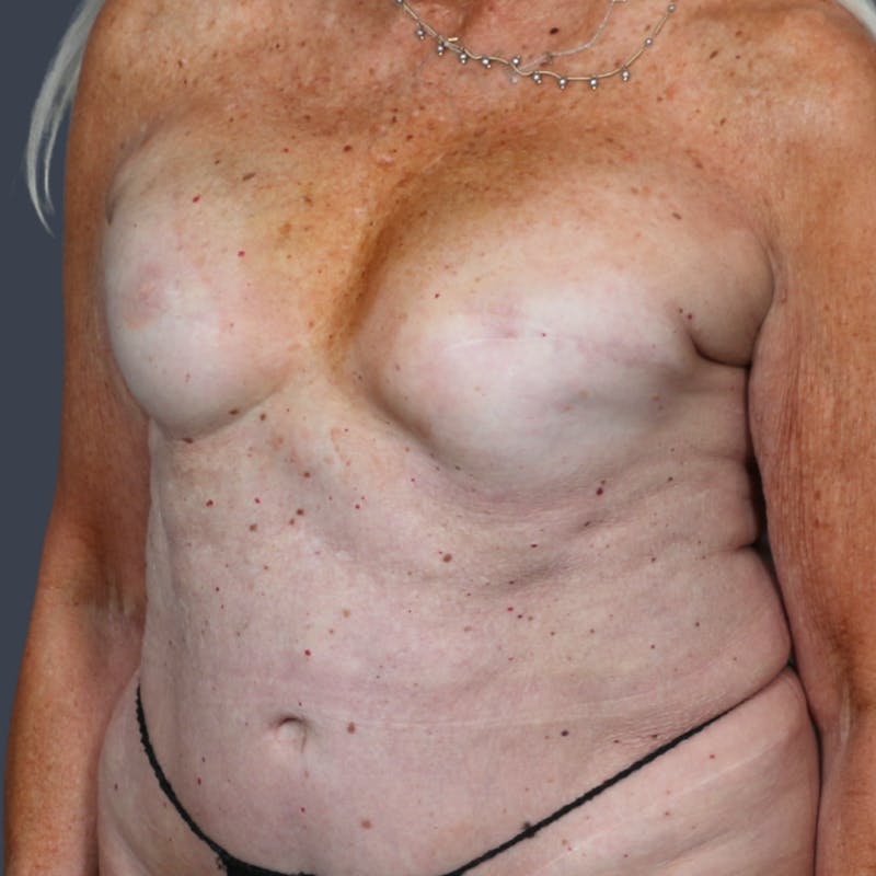 Breast Reconstruction Revision Before & After Gallery - Patient 134610 - Image 3