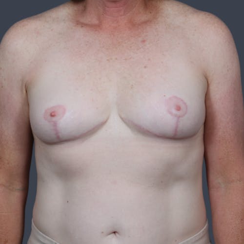 After procedure image for Breast Reduction