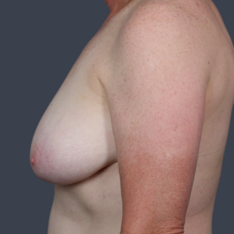 Breast Reduction Before & After Gallery - Patient 362384 - Image 3